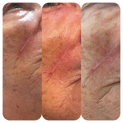 Face Scar Therapy