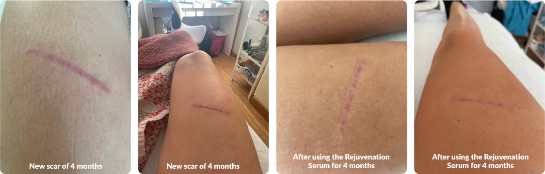 Scar Therapy Surrey